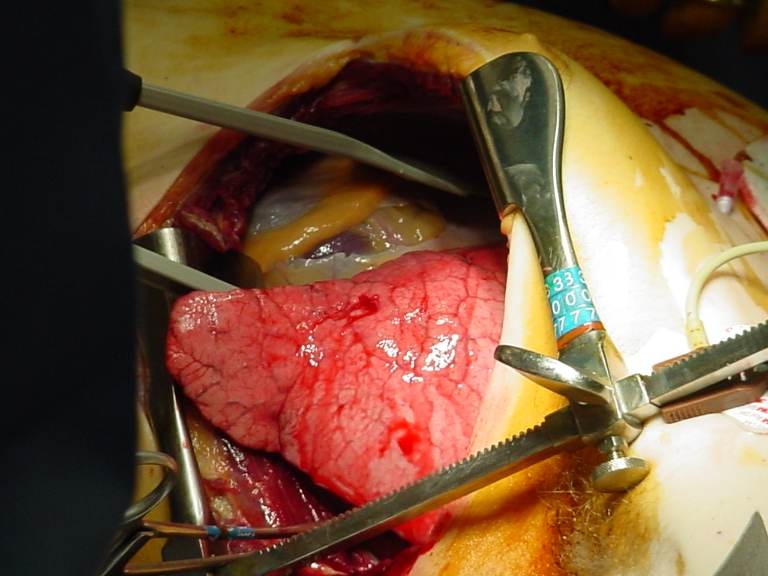 Operative image classified as OPERATIVE: an open left thoracic cavity during emergency resuscitative thoracotomy, with the lung and mediastinal structures exposed and instruments maintaining the operative field. The image supports the confirmed finding of an opened pericardium during traumatic arrest management; the exact rhythm and coronary anatomy are not independently established by the image. teaching image