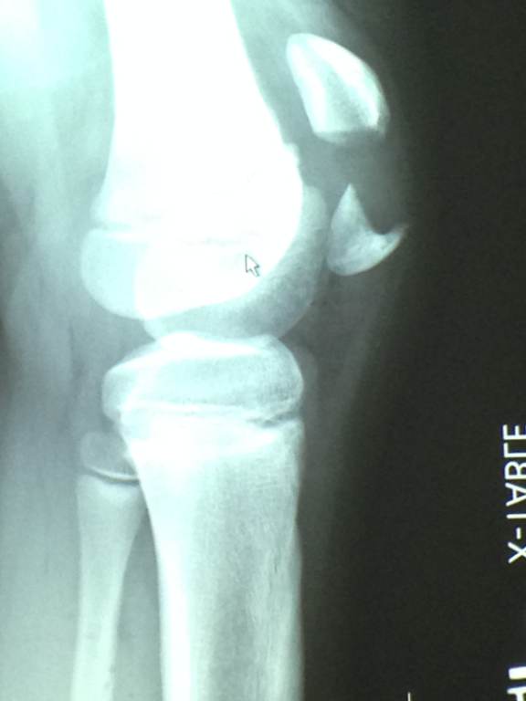 Diagnostic imaging: lateral knee radiograph showing a stable, minimally displaced patella fracture without documented dislocation or other acute fracture. teaching image