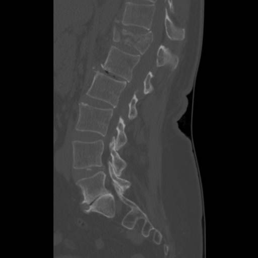 Diagnostic imaging: sagittal CT reconstruction of the lumbar spine demonstrating a flexion-distraction (Chance-type) vertebral fracture pattern; correlate with the seatbelt sign and abdominal pain while evaluating for associated hollow-viscus injury. teaching image
