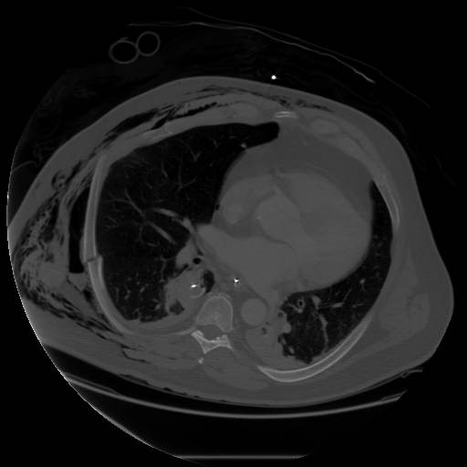 Axial contrast-enhanced CT of the chest obtained after initial resuscitation, showing extensive right-sided subcutaneous emphysema, a right thoracostomy tube, right pneumothorax and hemothorax with adjacent pulmonary contusion or laceration, and bilateral dependent air-space opacities. teaching image