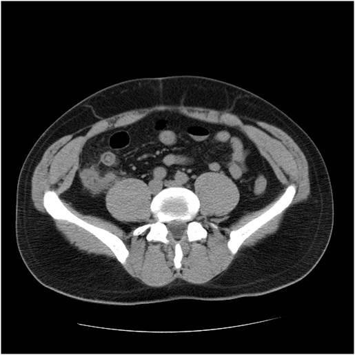 CT appearance of acute appendicitis from the ACS image archive.