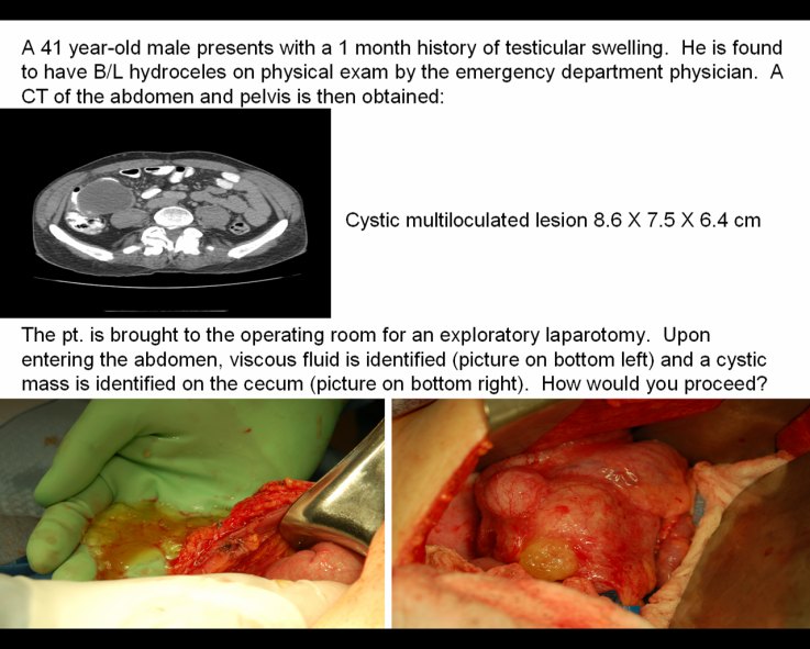 Appendiceal mucocele image from the ACS image archive.
