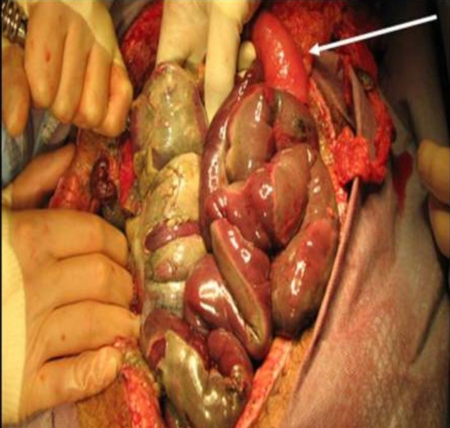 Bowel ischemia operative image from the ACS image archive.