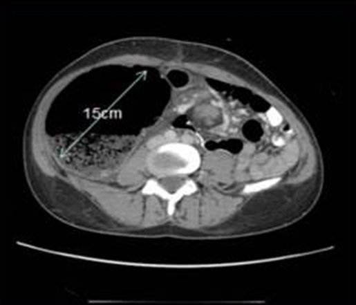 CT appearance of cecal volvulus from the ACS image archive.