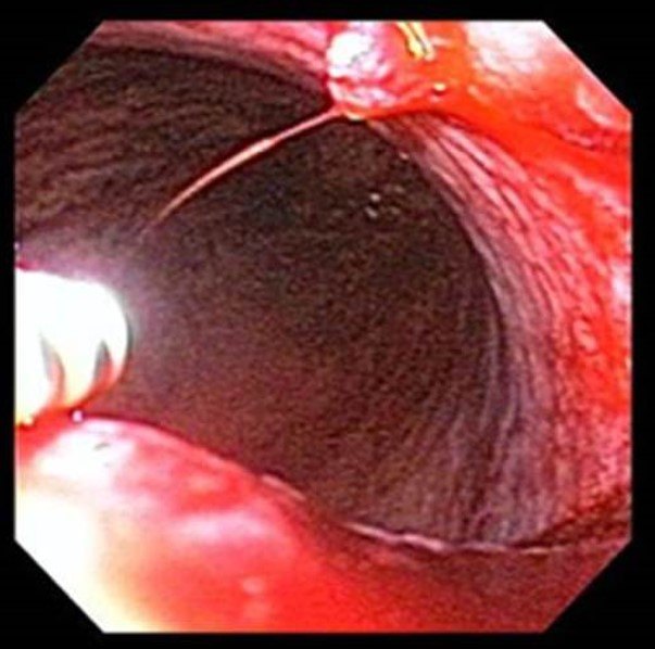 Endoscopic bleeding lesion from the ACS image archive.