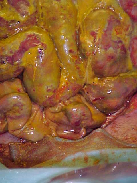 Fecal peritonitis operative image from the ACS image archive.