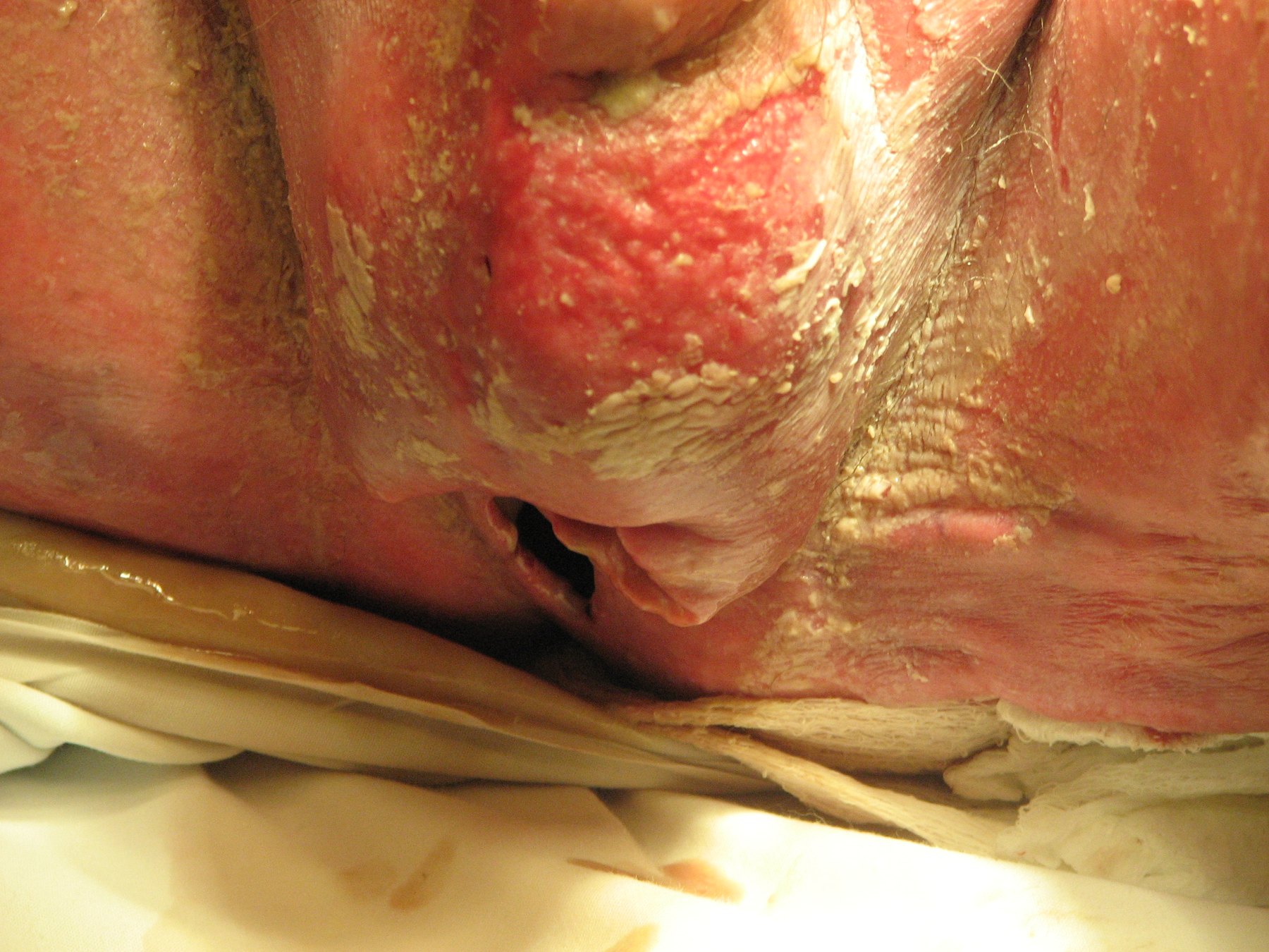 Fournier gangrene clinical image from the ACS image archive.