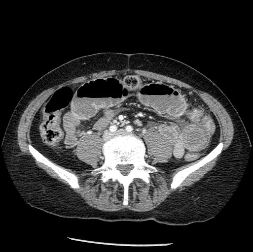 Target sign associated with intussusception from the ACS image archive.