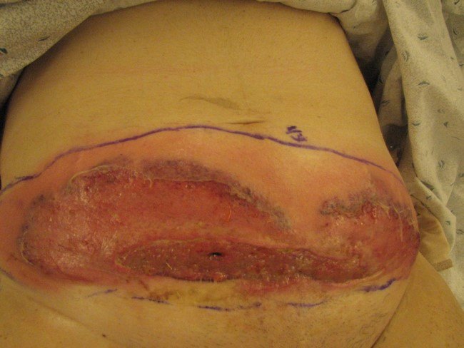 Necrotizing soft-tissue infection from the ACS image archive.