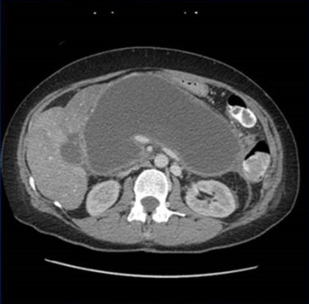 Pancreatic pseudocyst image from the ACS image archive.
