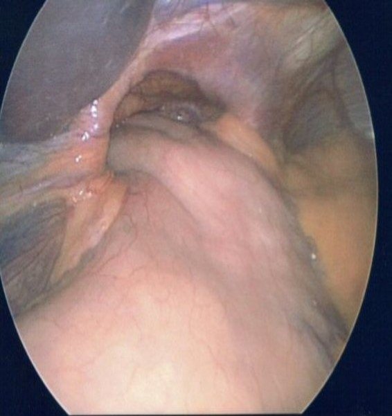 Paraesophageal hernia image from the ACS image archive.