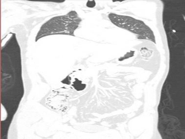Pneumatosis intestinalis image from the ACS image archive.