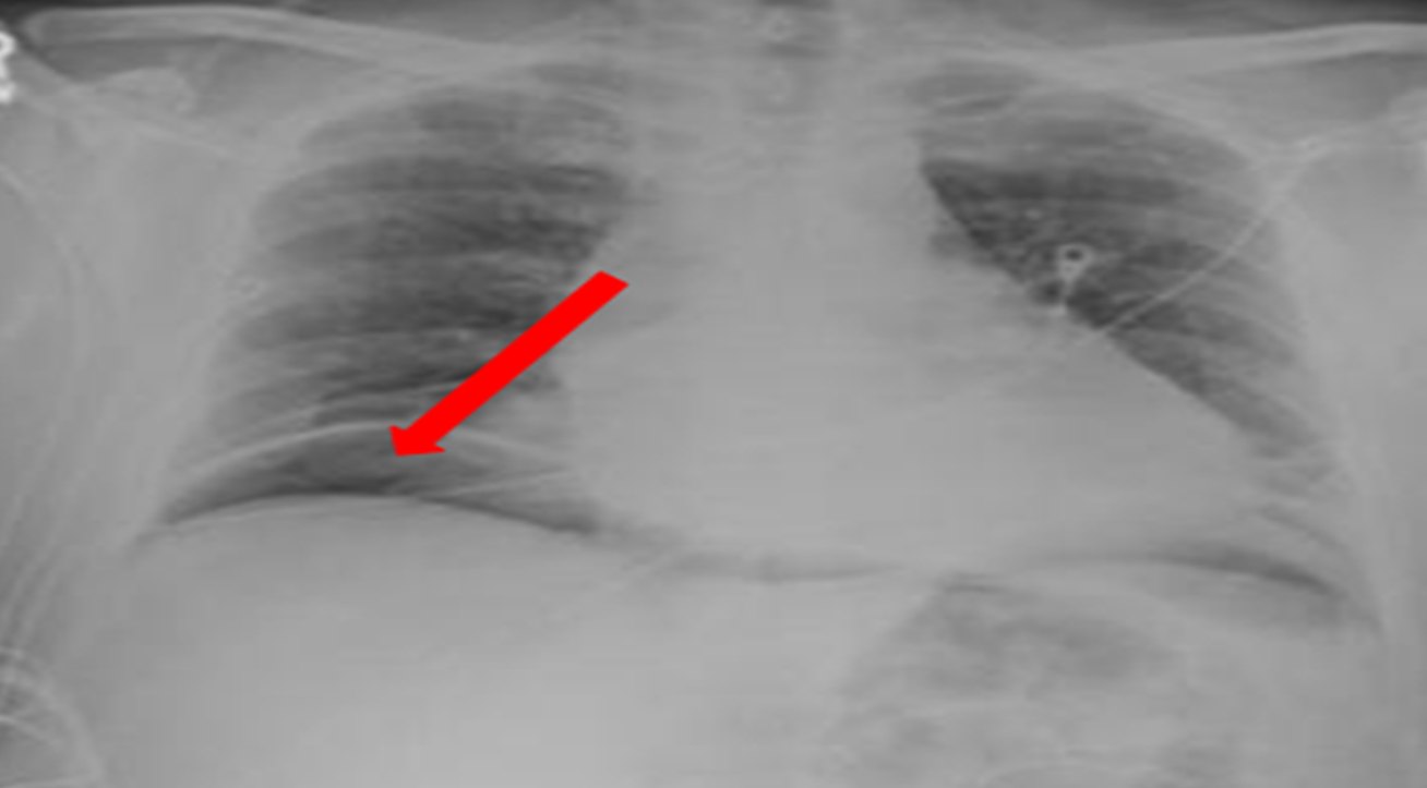 Free intraperitoneal air from the ACS image archive.