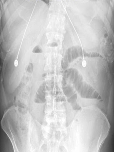 Small-bowel obstruction imaging from the ACS image archive.