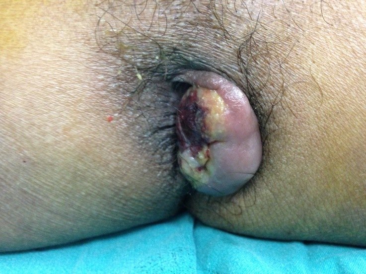 Thrombosed external hemorrhoid from the ACS image archive.