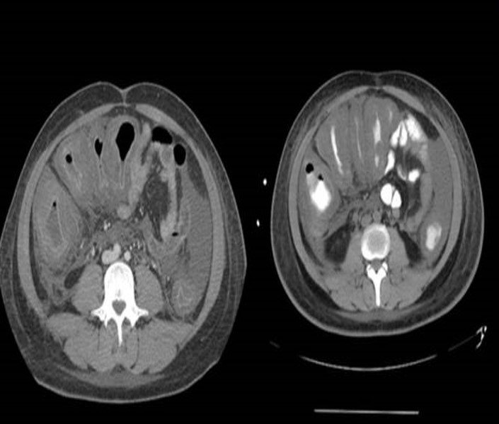 Toxic megacolon imaging from the ACS image archive.